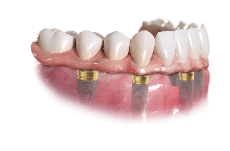 Fixed full-arch dental implant bridge