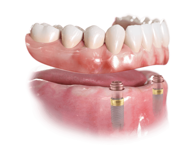 Removable implant-retained lower denture