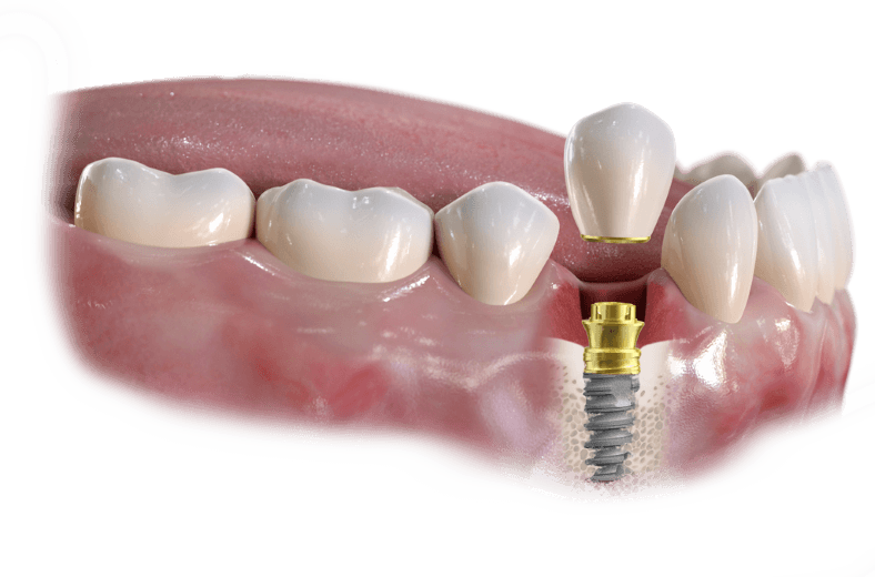 Single-tooth dental implant with crown