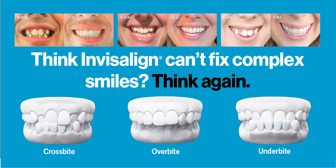 Invisalign treatment examples for crossbite, overbite, and underbite